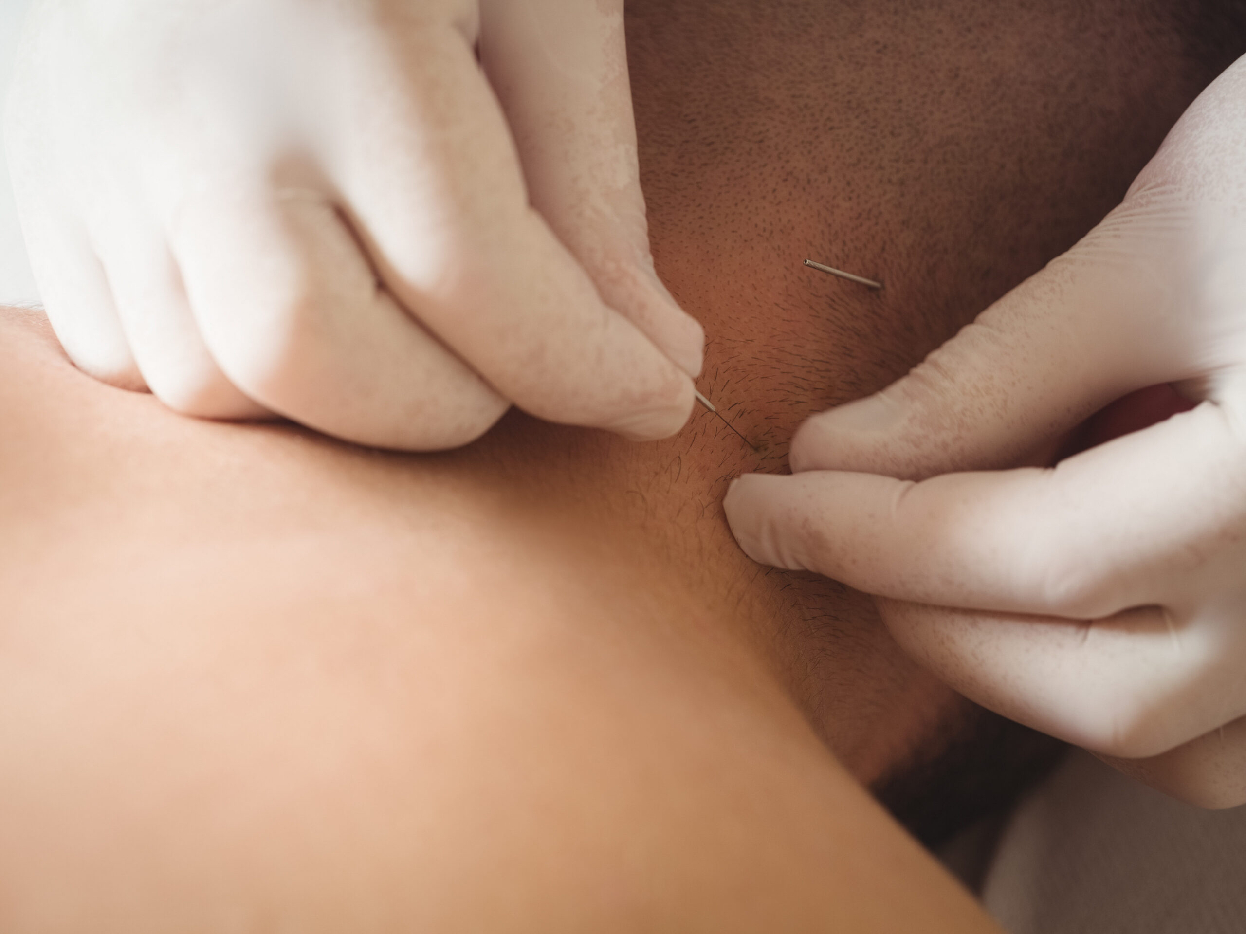 Acupuntura